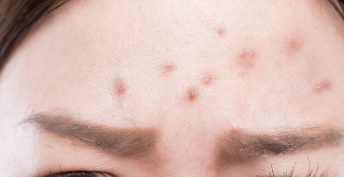 Eau micellaire pour peau acnéique