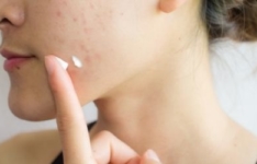 Les meilleurs produits contre l’acné