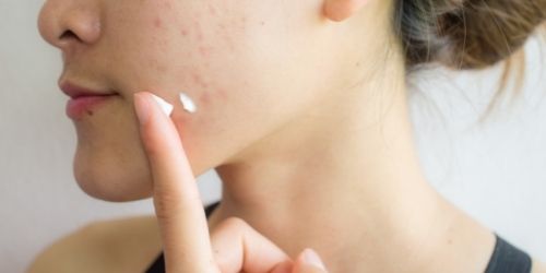 Les meilleurs produits contre l'acné