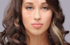 Les meilleurs traitements des cicatrices d’acné
