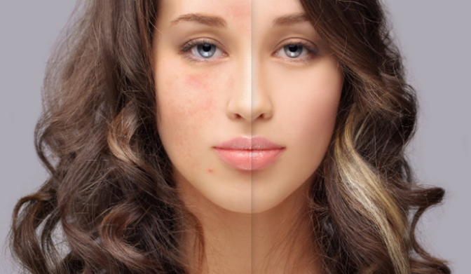 Les meilleurs traitements des cicatrices d'acné